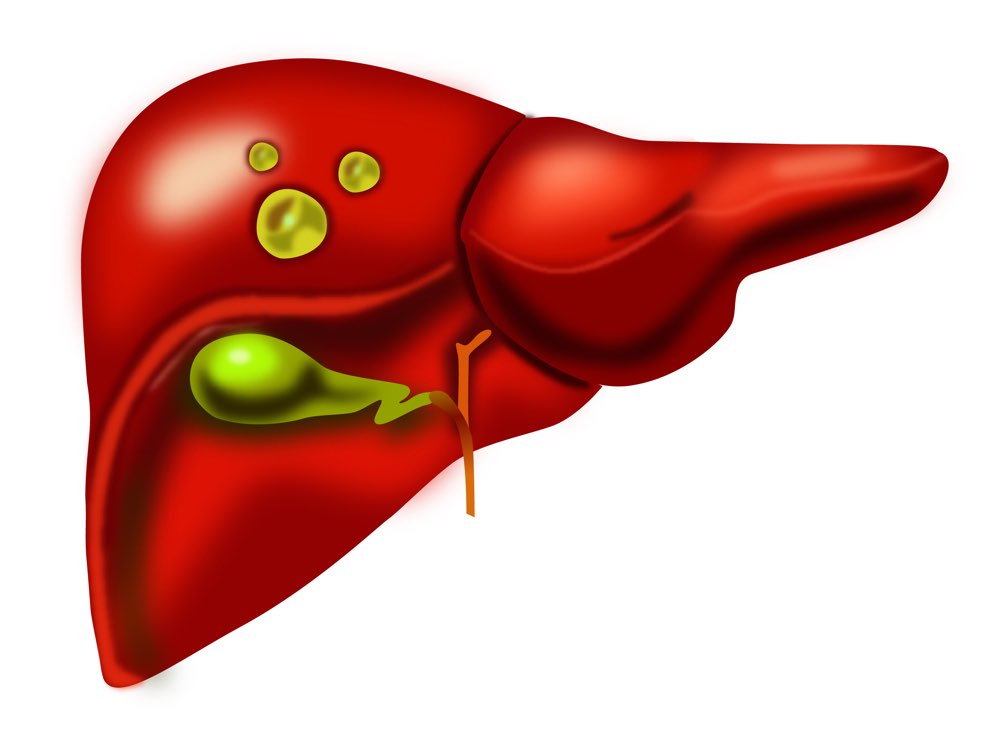 liver cysts
