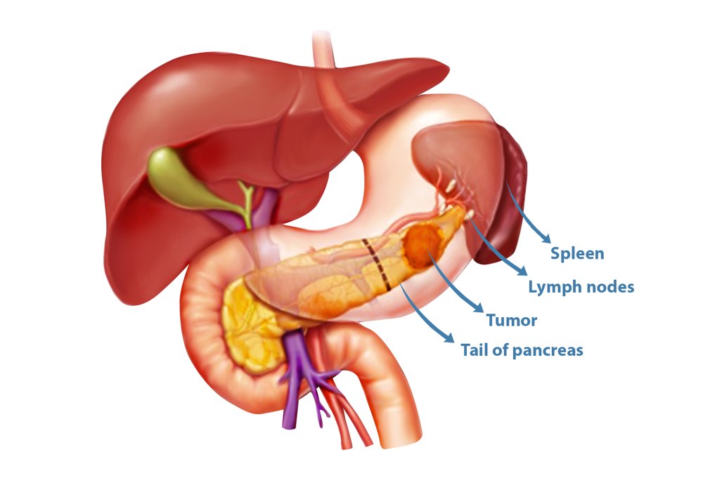 pancreas surgery